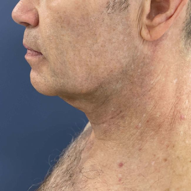 image before myellevate - male adult patient left angle case 6455