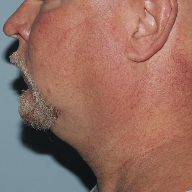 image before myellevate - minimally invasive neck lift left angle case 6452