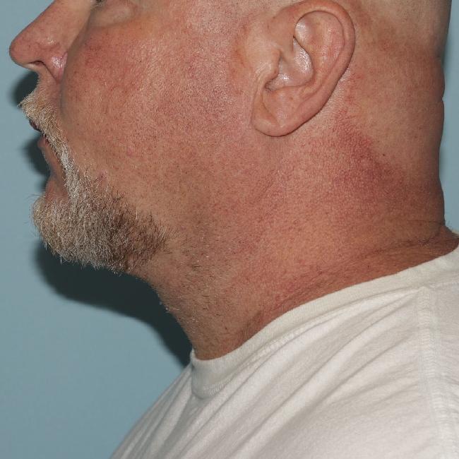 image after myellevate - minimally invasive neck lift left angle case 6452