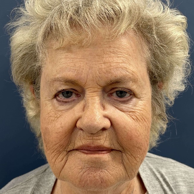 NeoGen PSR/ Sciton BBL Combination Therapy Before and After Image Case number 2