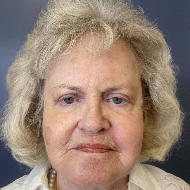 NeoGen PSR/ Sciton BBL Combination Therapy Before and After Image Case number 2