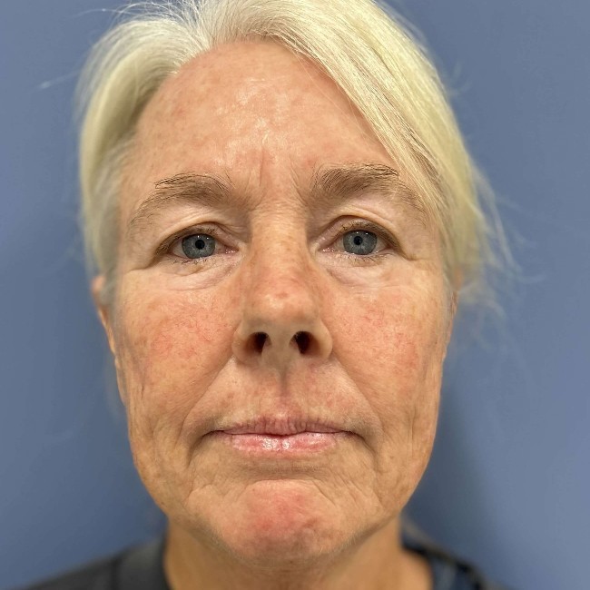 NeoGen PSR/ Sciton BBL Combination Therapy Before and After Image Case number 1 - 5001