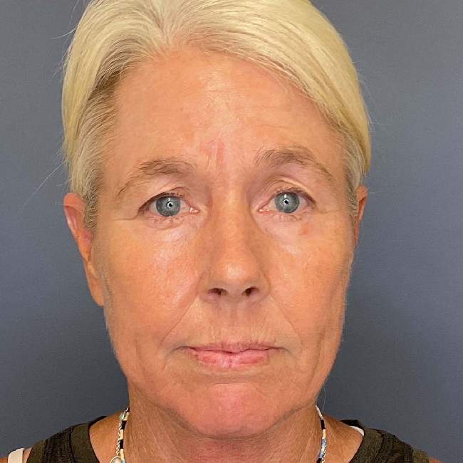 NeoGen PSR/ Sciton BBL Combination Therapy Before and After Image Case number 1 - 5002