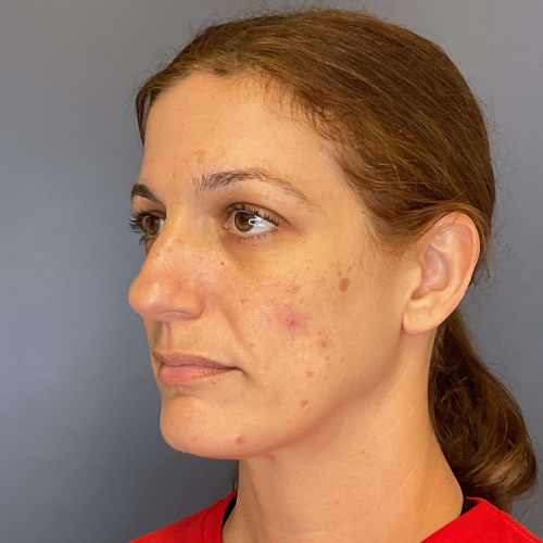 Before sciton bbl broadband light Left Side 45 degree View Case 7894