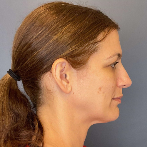 Before sciton bbl broadband light Right Side View Case 7894