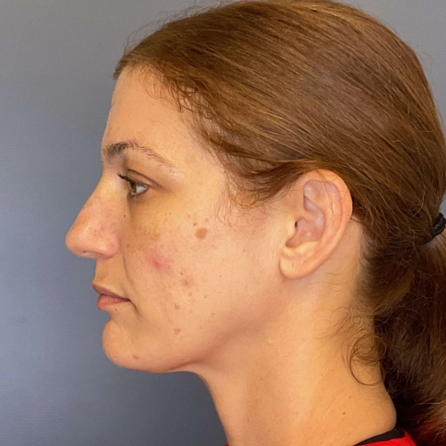 Before sciton bbl broadband light Left Side View Case 7894