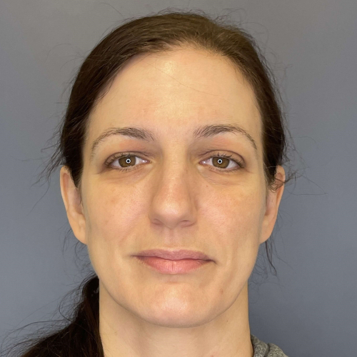 Sciton BBL BroadBand Light Before and After Image Case Number 7894 - After Front