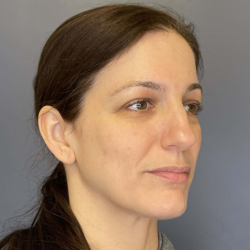 Sciton BBL BroadBand Light Before and After Image Case 7894- After Front