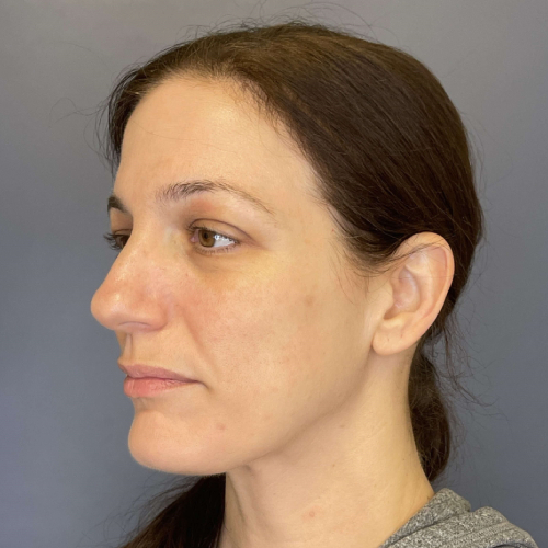 Sciton BBL BroadBand Light Before and After Image Case 7894- After Left Side 45 degree View