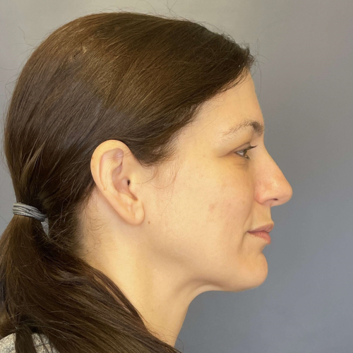 Sciton BBL BroadBand Light Before and After Image Case 7894- After Right Side View