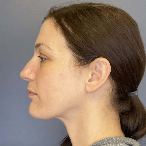 Sciton BBL BroadBand Light Before and After Image Case 7894- After Left Side View