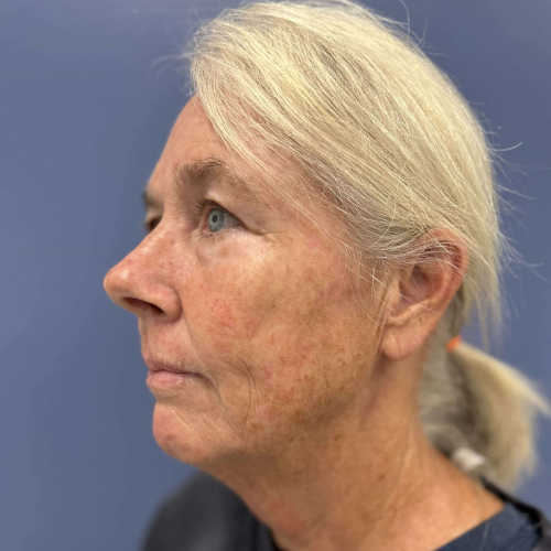 NeoGen PSR/ Sciton BBL Combination Therapy Before & After - Before Photo Left side 45 degree View 7906