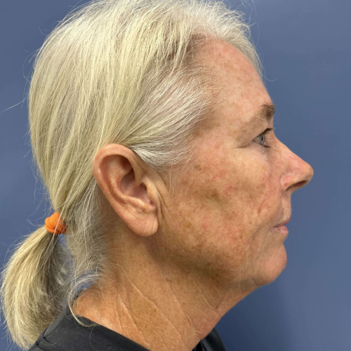 NeoGen PSR/ Sciton BBL Combination Therapy Before & After - Before Photo right side View 7906
