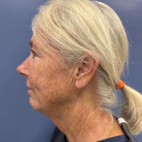 NeoGen PSR/ Sciton BBL Combination Therapy Before & After - Before Photo Left side View 7906