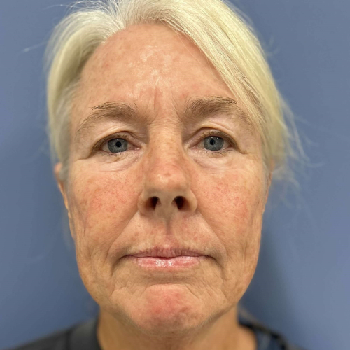 NeoGen PSR/ Sciton BBL Combination Therapy Before & After - Before Photo Front View 7906