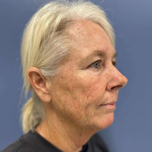 NeoGen PSR/ Sciton BBL Combination Therapy Before & After - Before Photo right side 45 degree View 7906