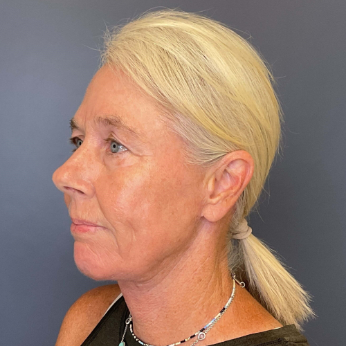 NeoGen PSR/ Sciton BBL Combination Therapy Before & After - After Photo Left side 45 degree View 7906