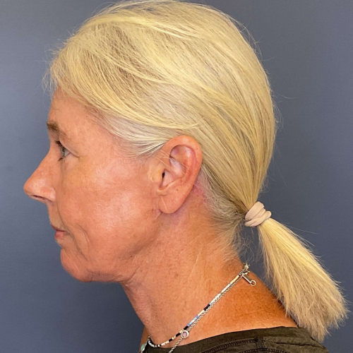 NeoGen PSR/ Sciton BBL Combination Therapy Before & After - After Photo Left side View 7906
