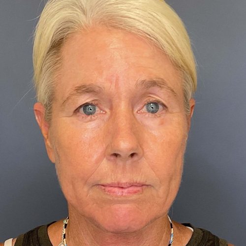 NeoGen PSR/ Sciton BBL Combination Therapy Before & After - After Photo Front side View 7906