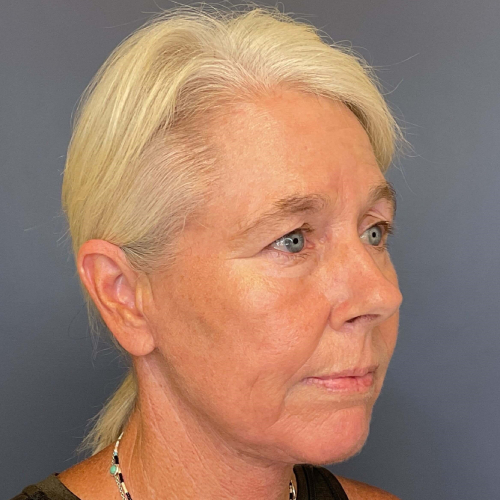 NeoGen PSR/ Sciton BBL Combination Therapy Before & After - After Photo Right side 45 degree View 7906