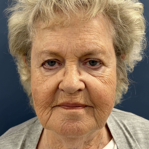 Sciton BBL Broadband Light Before Photo Front Side View 7917