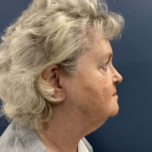 Sciton BBL Broadband Light Before Photo Right Side View 7917