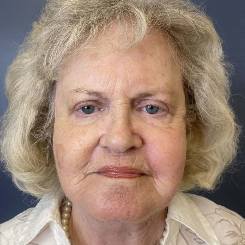 Sciton BBL Broadband Light After Photo Front Side View 7917