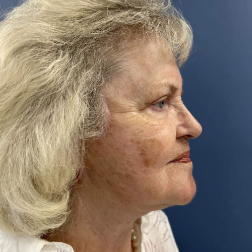 Sciton BBL Broadband Light After Photo Right Side View 7917