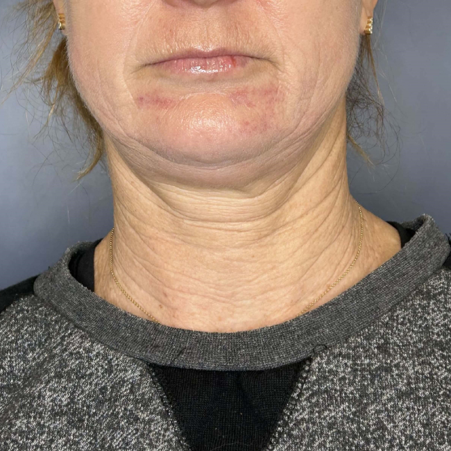 before Sofwave female patient front view case 6992