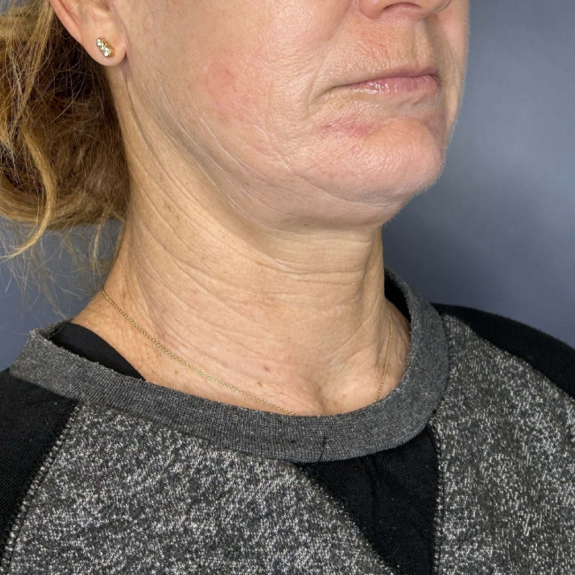 before Sofwave female patient right angle view case 6992