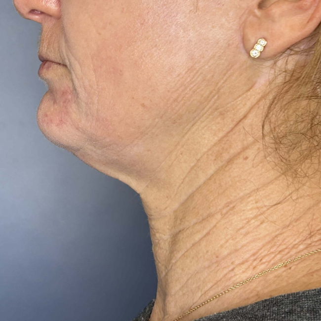 before Sofwave female patient left view case 6992