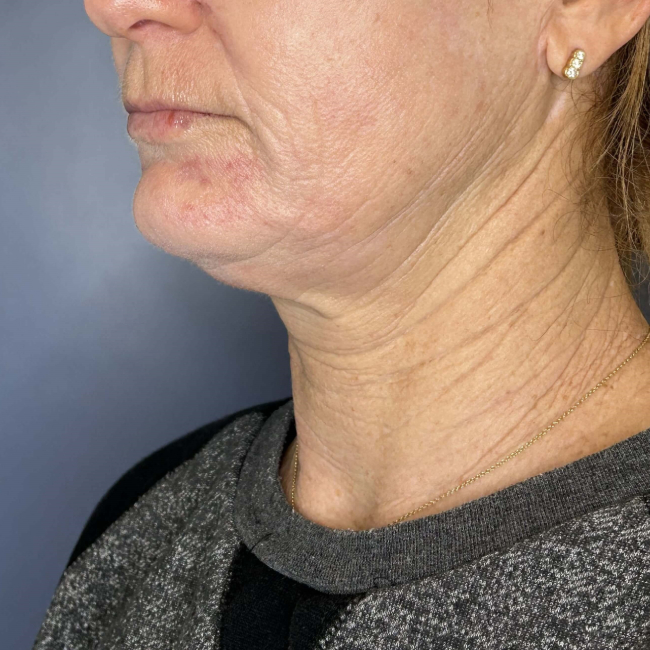 before Sofwave female patient left angle view case 6992