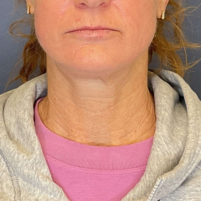 after Sofwave female patient front view case 6992