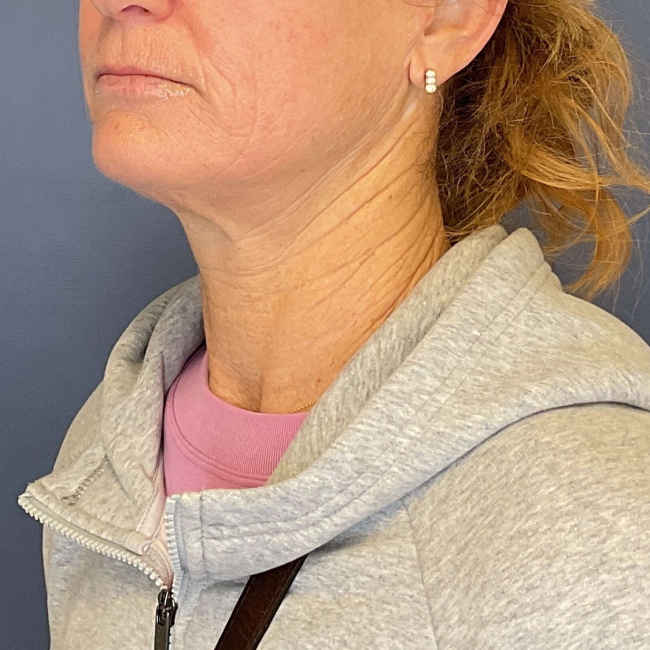 after Sofwave female patient left angle view case 6992