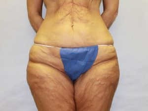 before thigh lift female patient front view case 5482