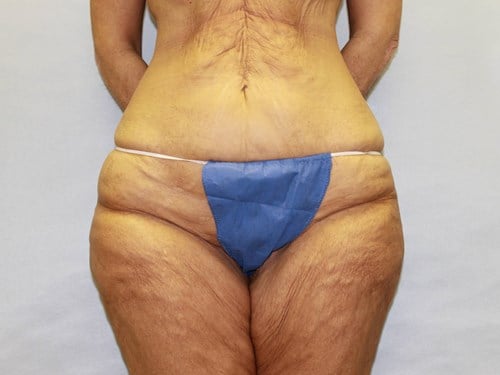 before thigh lift female patient front view case 5482