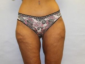 after thigh lift female patient front view case 5482