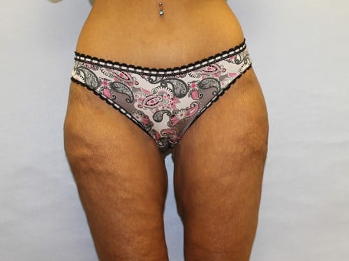 after thigh lift female patient front view case 5482