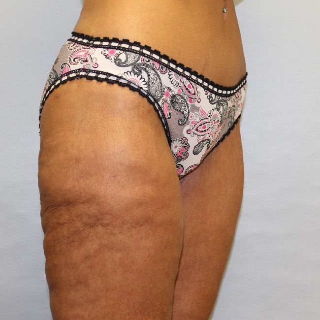 after thigh lift female patient right angle case 5482