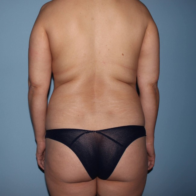 before tummy tuck - mommy makeover with fat grafting back view case 6939