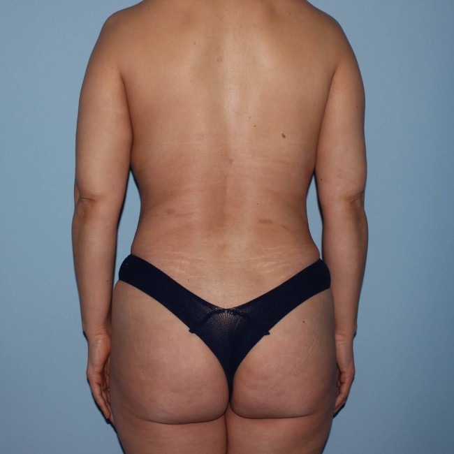 after tummy tuck - mommy makeover with fat grafting back view case 6939