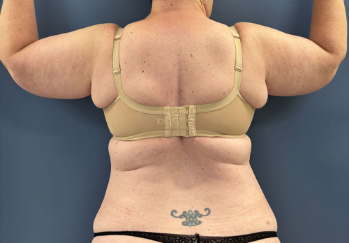 image before arm lift - plus size brachioplasty back view case 8463