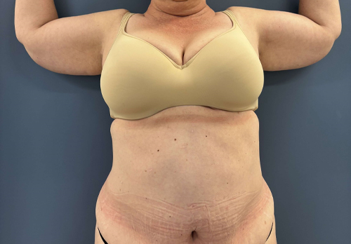 image before arm lift - plus size brachioplasty front view case 8463