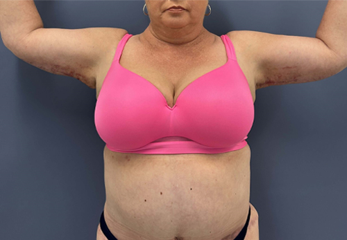 image after arm lift - plus size brachioplasty front view case 8463