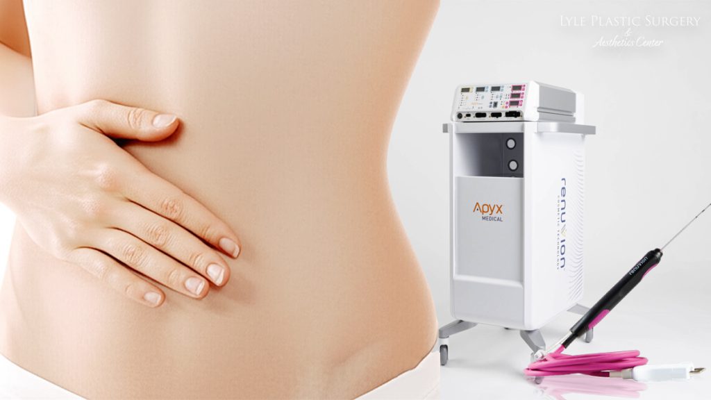 Stomach Skin Tightening with Renuvion – How It Can Help by Dr Glenn Lyle