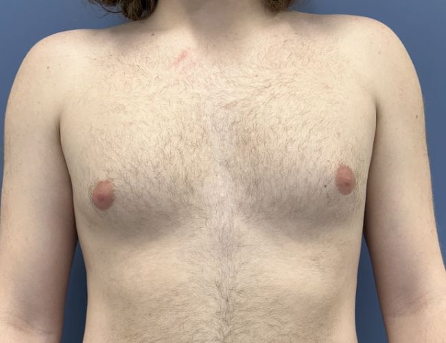 before gynecomastia surgery front view case 10882