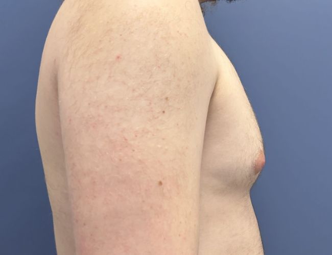 before gynecomastia surgery right side view case 10882