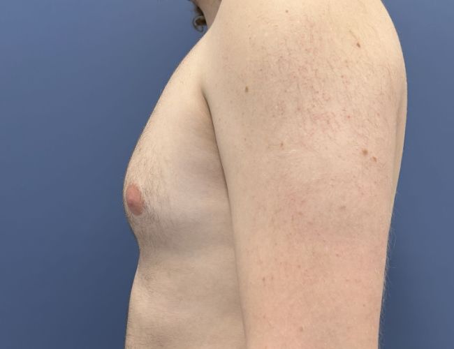 before gynecomastia surgery left side view case 10882