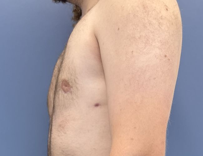 after gynecomastia surgery left side view case 10882