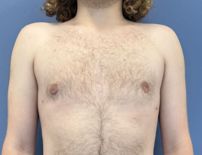 after gynecomastia surgery front view case 10882